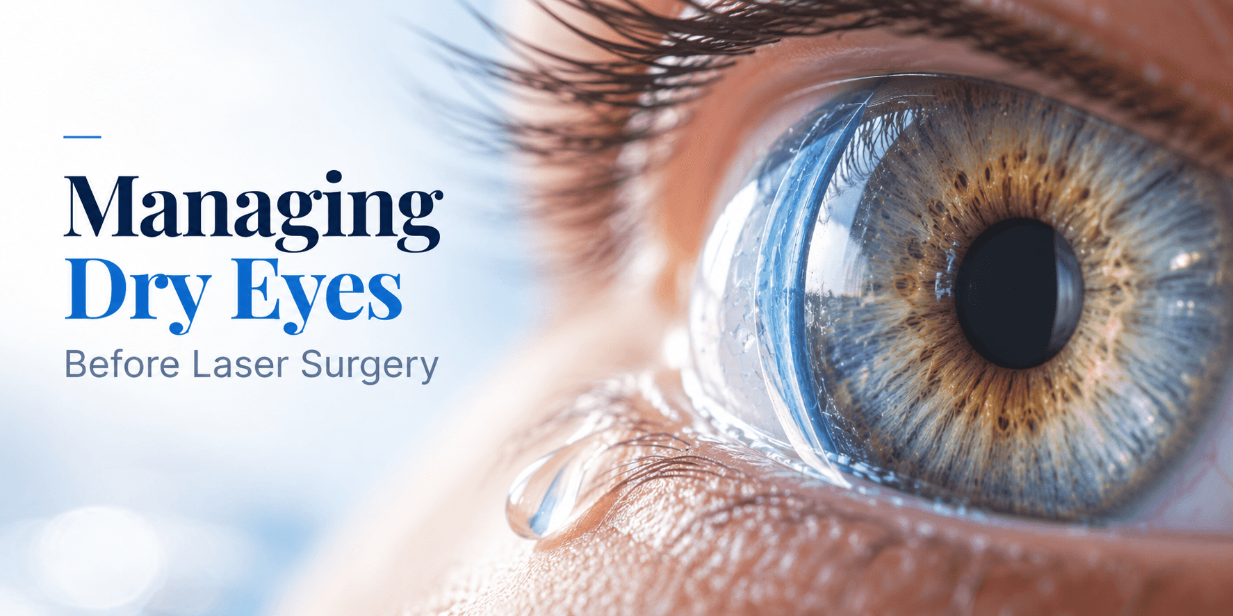 Managing dry eyes before laser surgery